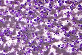 B cell Lymphoma cured by EGM