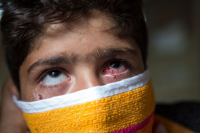 Pellet gun victim. The pellet guns used in Indian Occupied Kashmir are 12 gauge shotguns according to Scroll.in (Image via Al Jazeera) Pellet gun victim. The pellet guns used in Indian Occupied Kashmir are 12 gauge shotguns according to Scroll.in (Image via Al Jazeera)