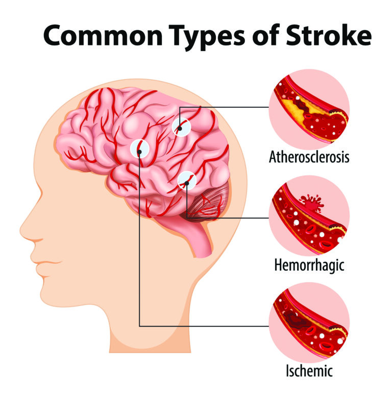 How to Prevent a Stroke